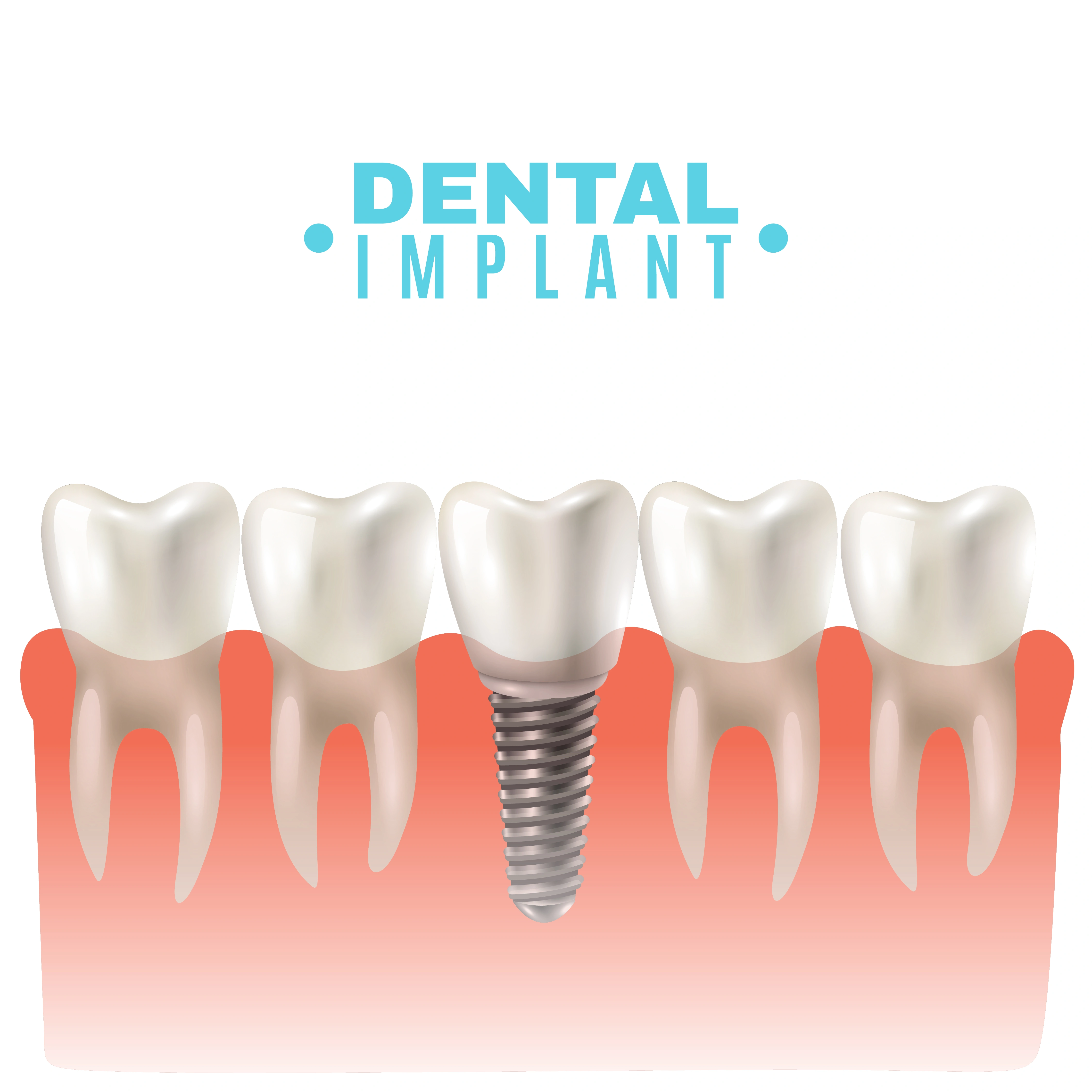 dental implant