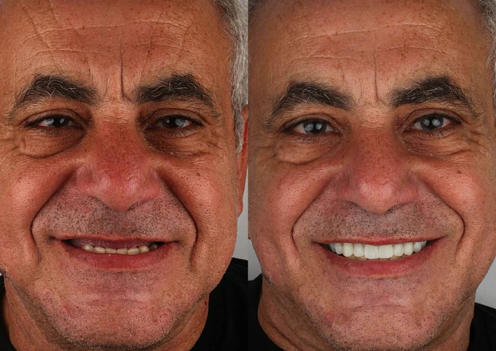 عملية زرع الأسنان