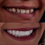 female veneers before and after look transformation