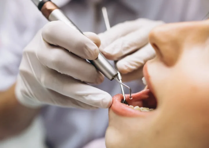 علاج تآكل الأسنان