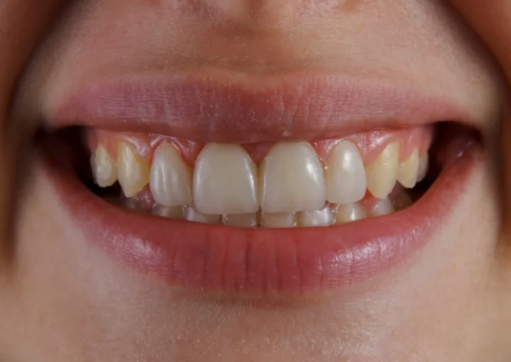 تنظيف الاسنان من التسوس
