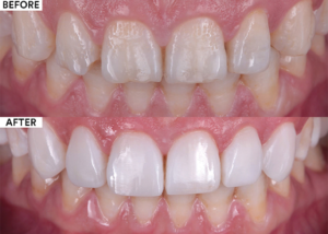 composite veneer before and after