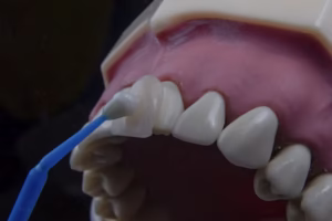 composite veneer