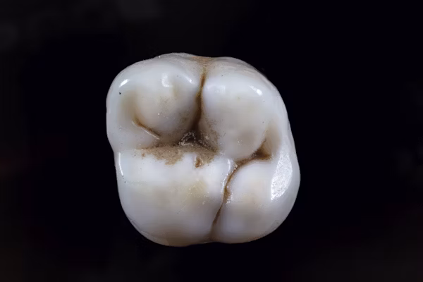 تسوس الاسنان