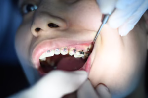 تقويم اسنان في التجمع الخامس
