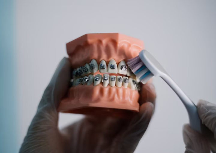 طريقة الأكل بعد تركيب التقويم