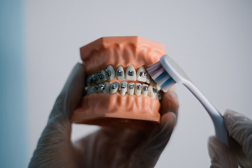 طريقة الأكل بعد تركيب التقويم