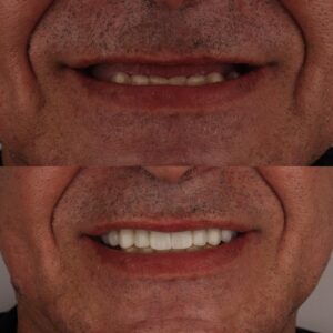 شكل زراعة الاسنان قبل وبعد