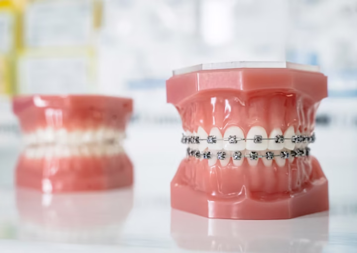 تقويم الاسنان المتحرك