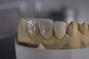 انواع طربوش الاسنان