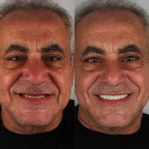 dental-implants-procedure