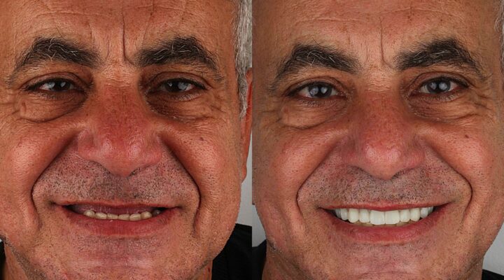 dental-implants-procedure