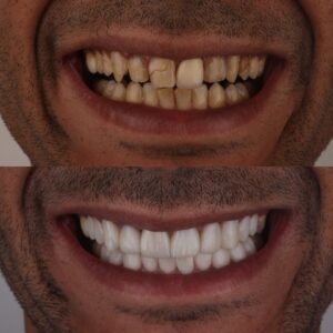 before and after veneers