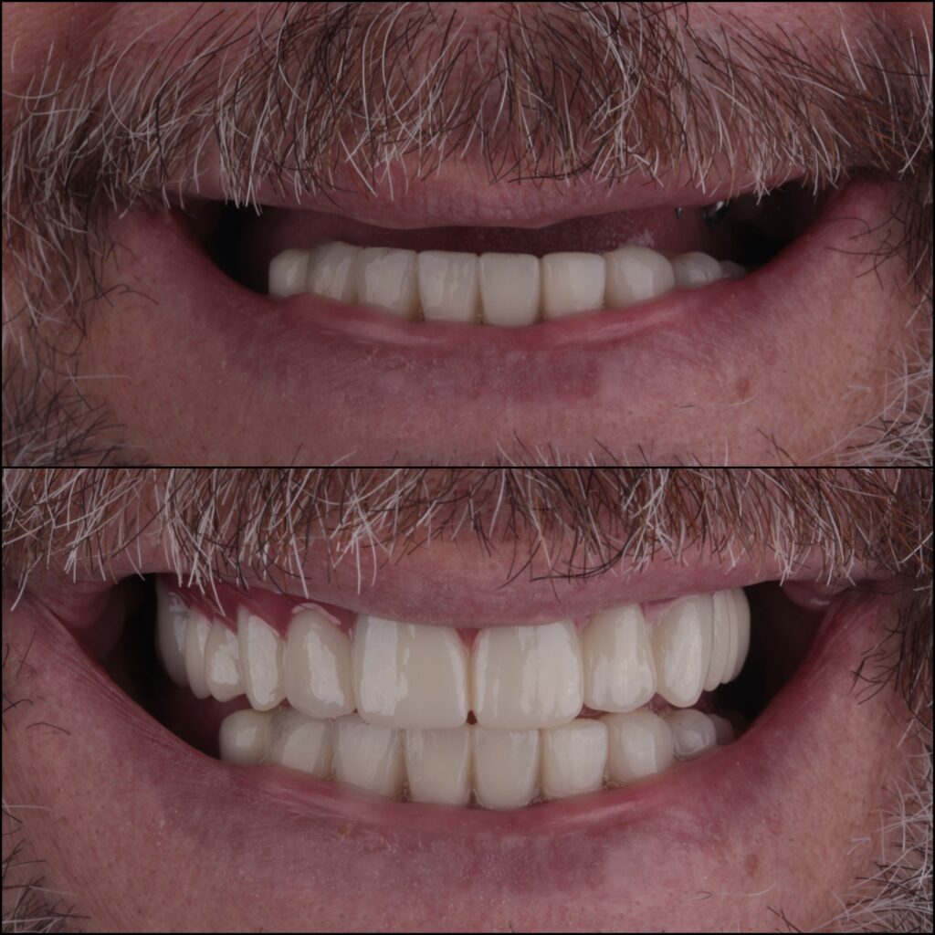 traditional and All-on-4 dental implants