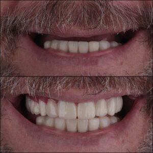 traditional and All-on-4 dental implants