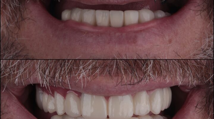 traditional and All-on-4 dental implants