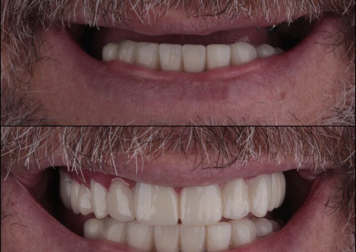 traditional and All-on-4 dental implants