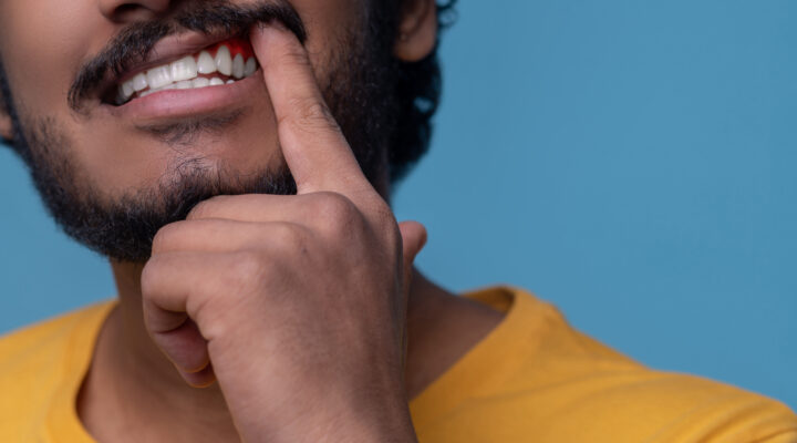 التهاب عصب الأسنان