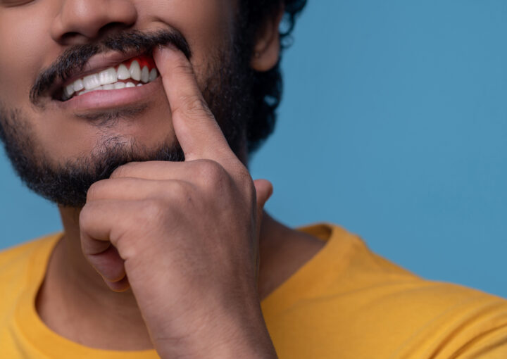 التهاب عصب الأسنان
