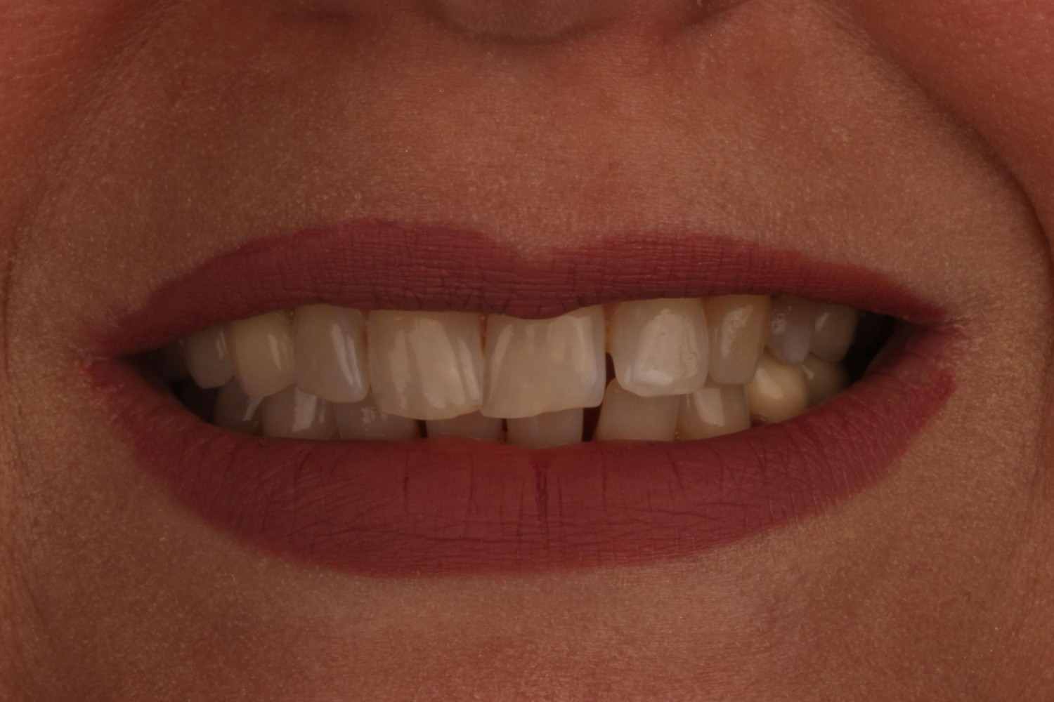 before veneers