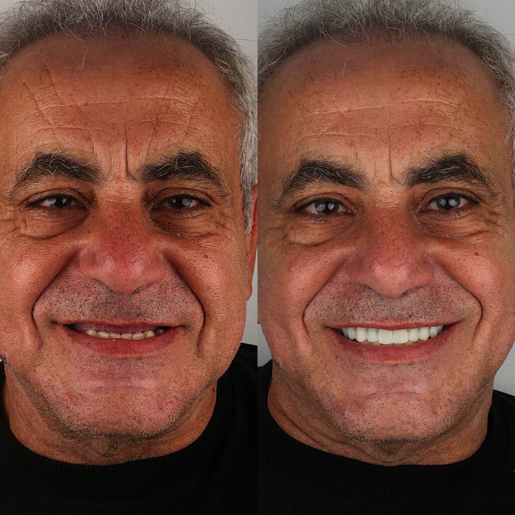dental implants