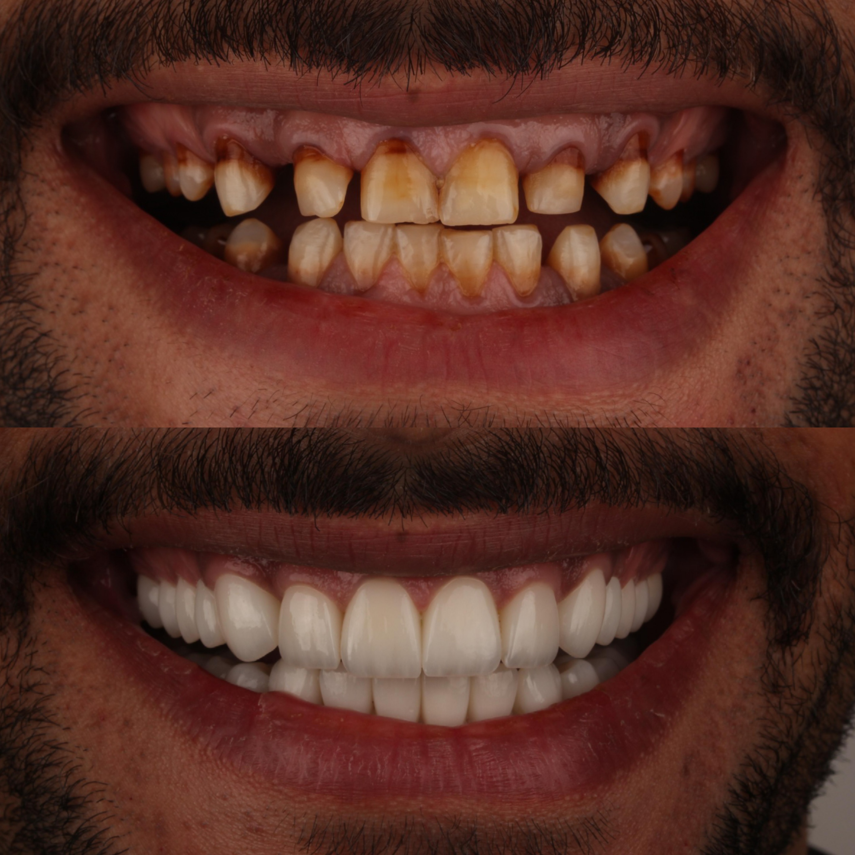 Veneers before and after