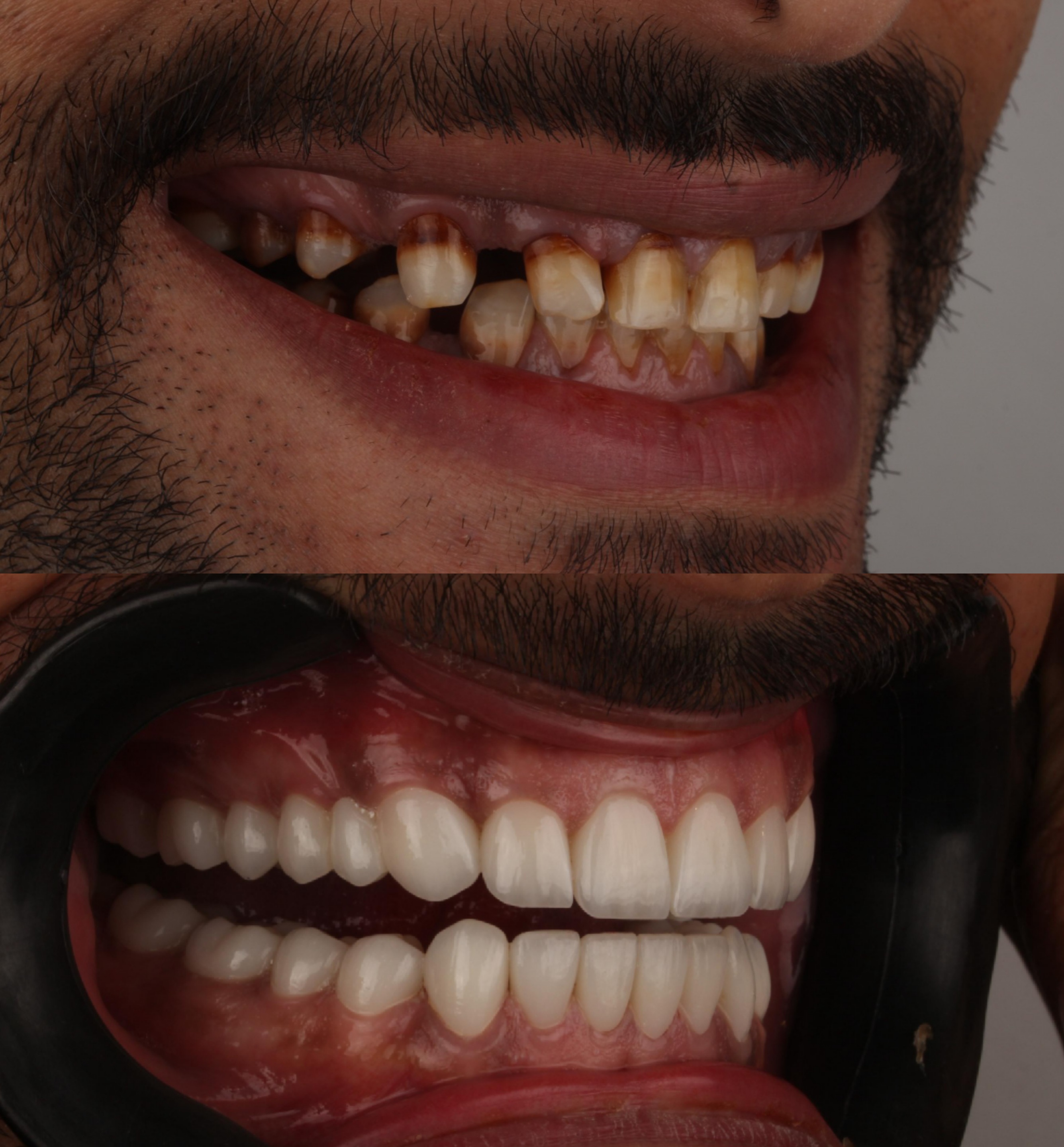 Veneers