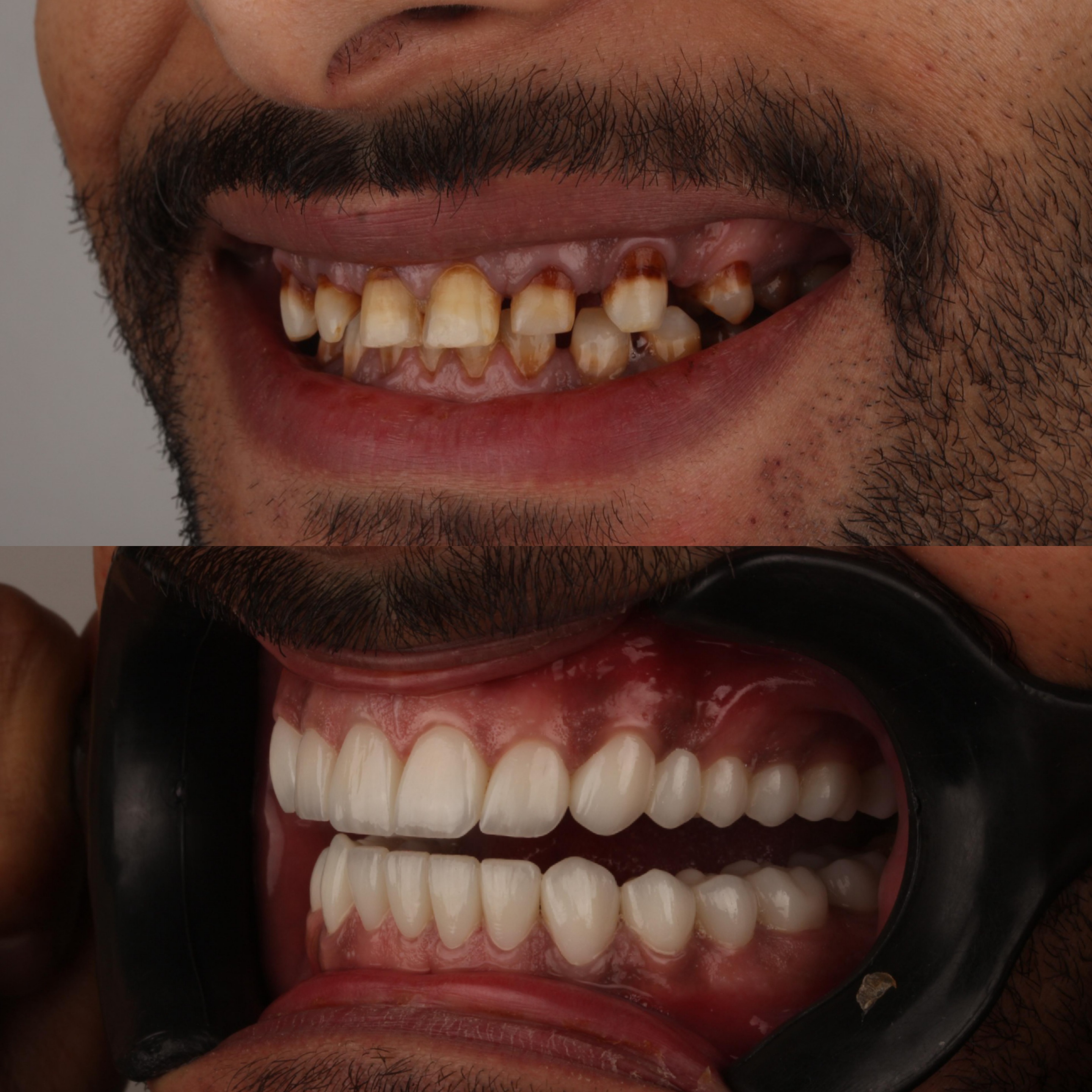 before and after veneers