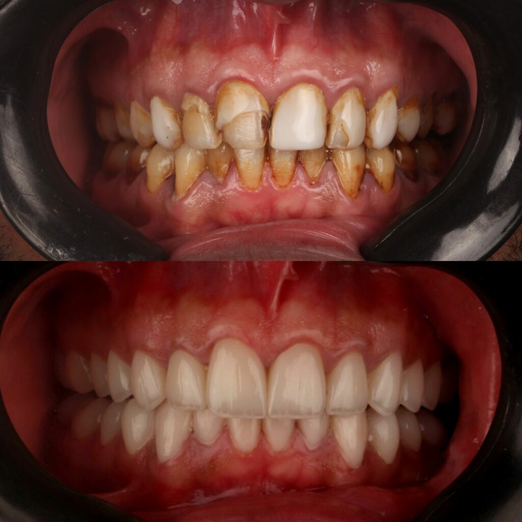 veneers