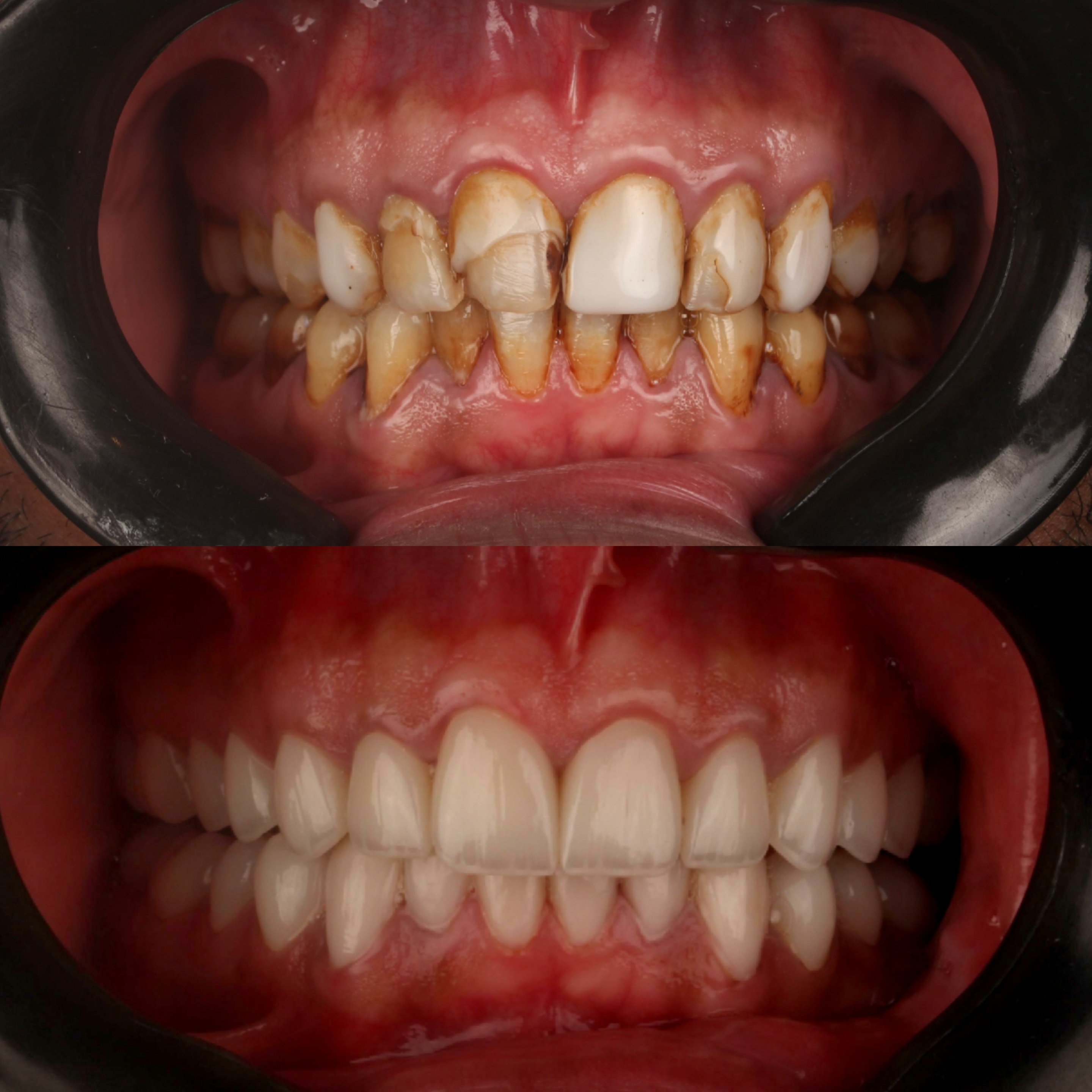 veneers