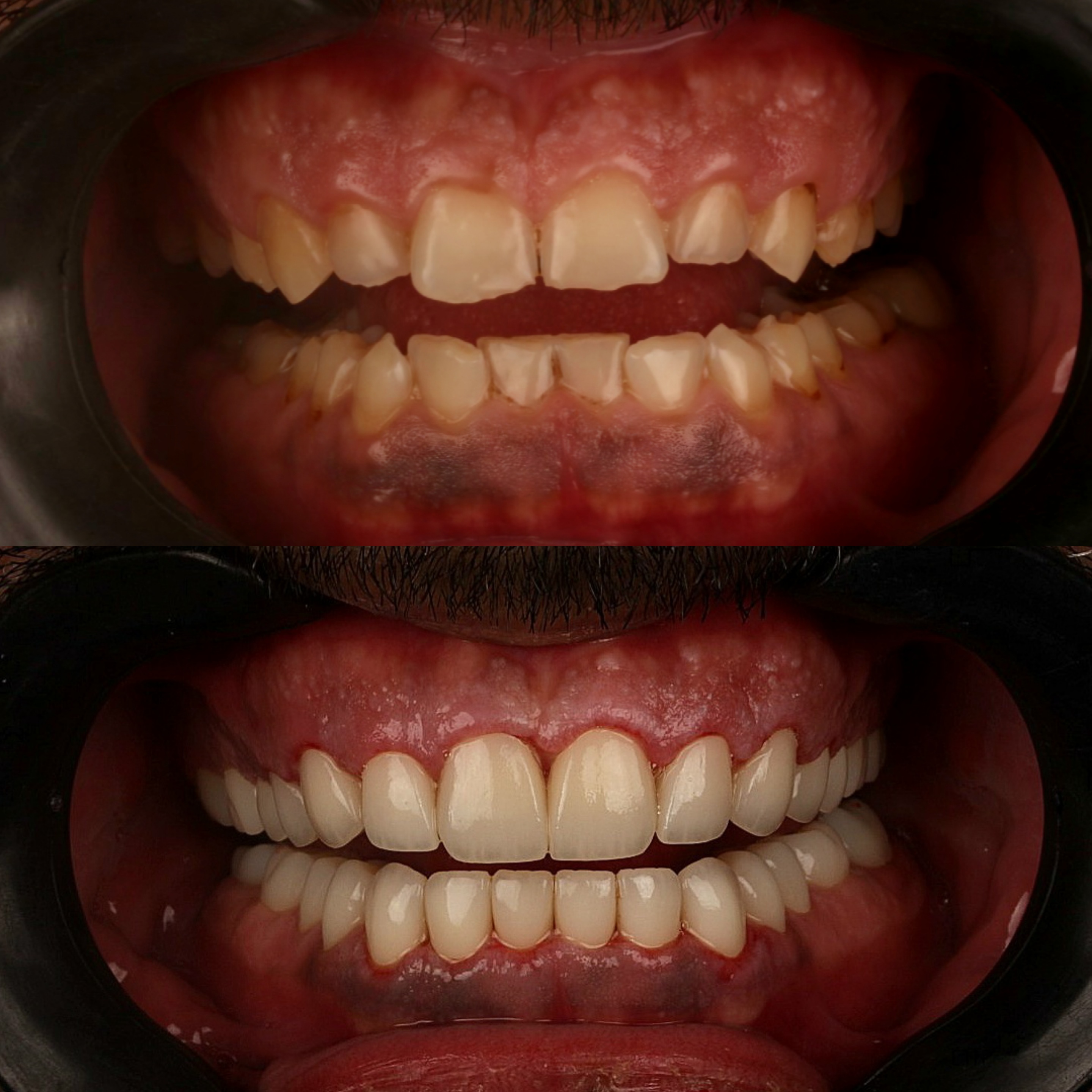 before and after veneers image