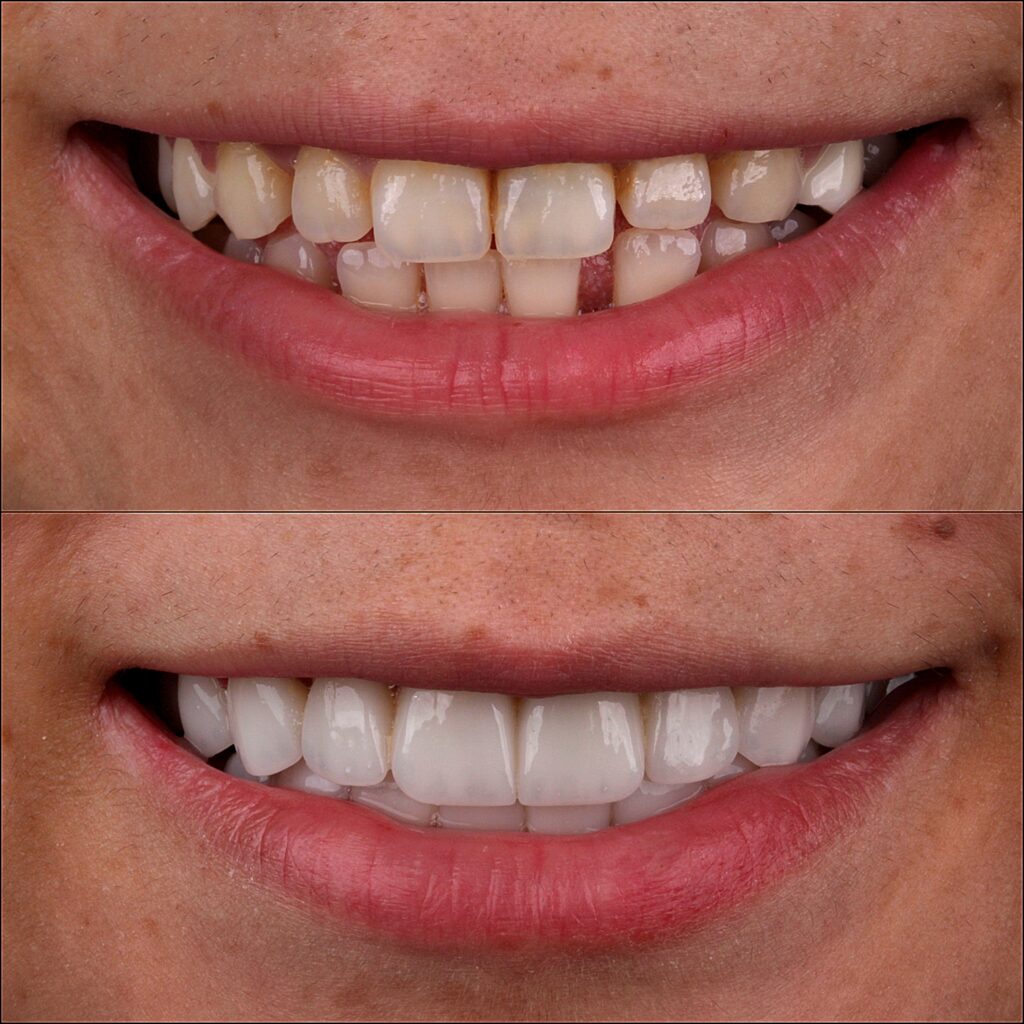 before and after veneers