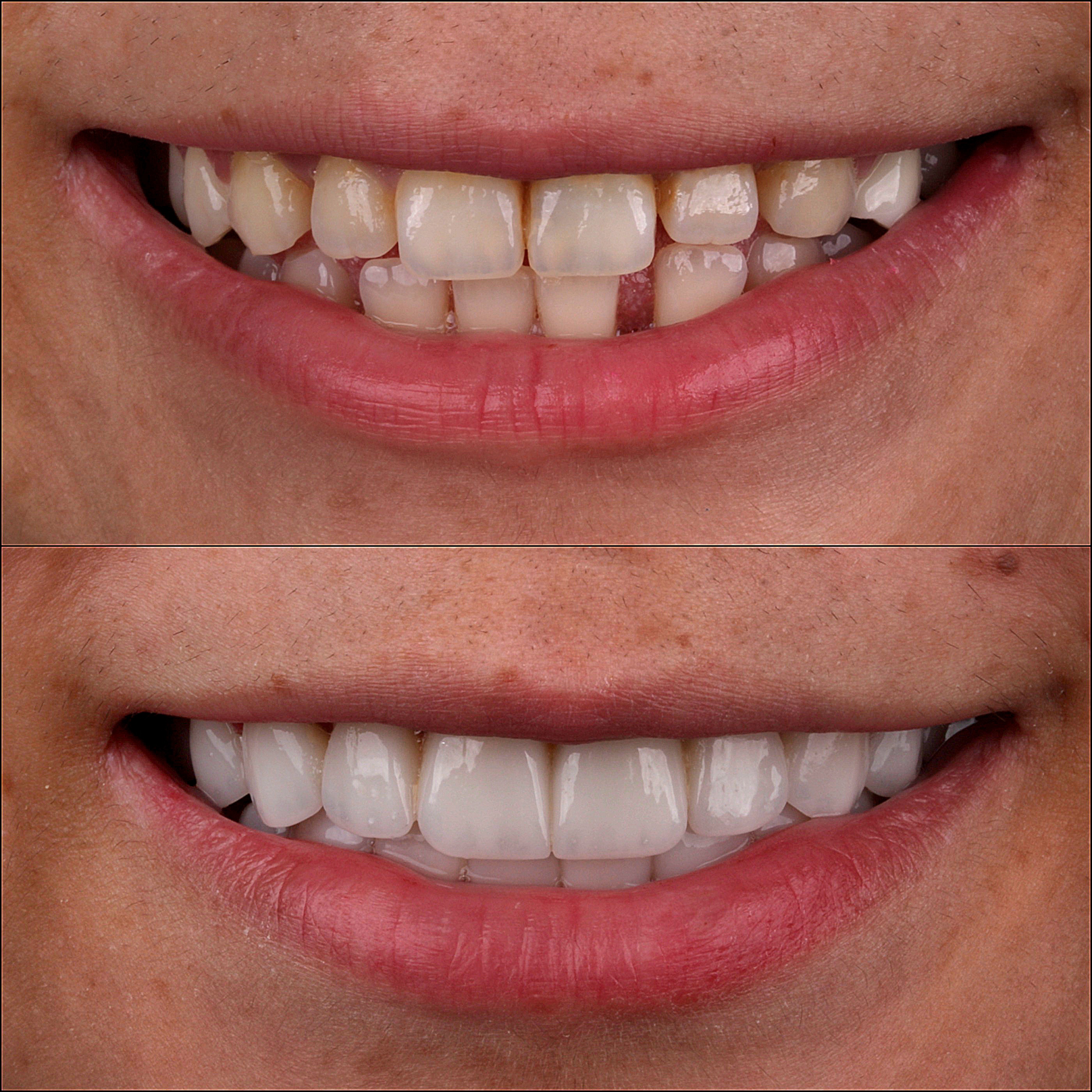 before and after veneers