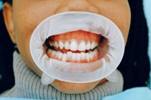 Gum Disease