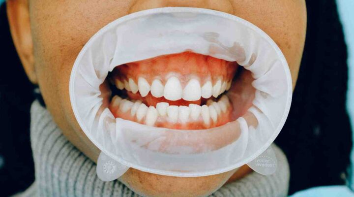 Gum Disease