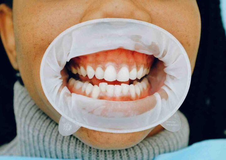 Gum Disease