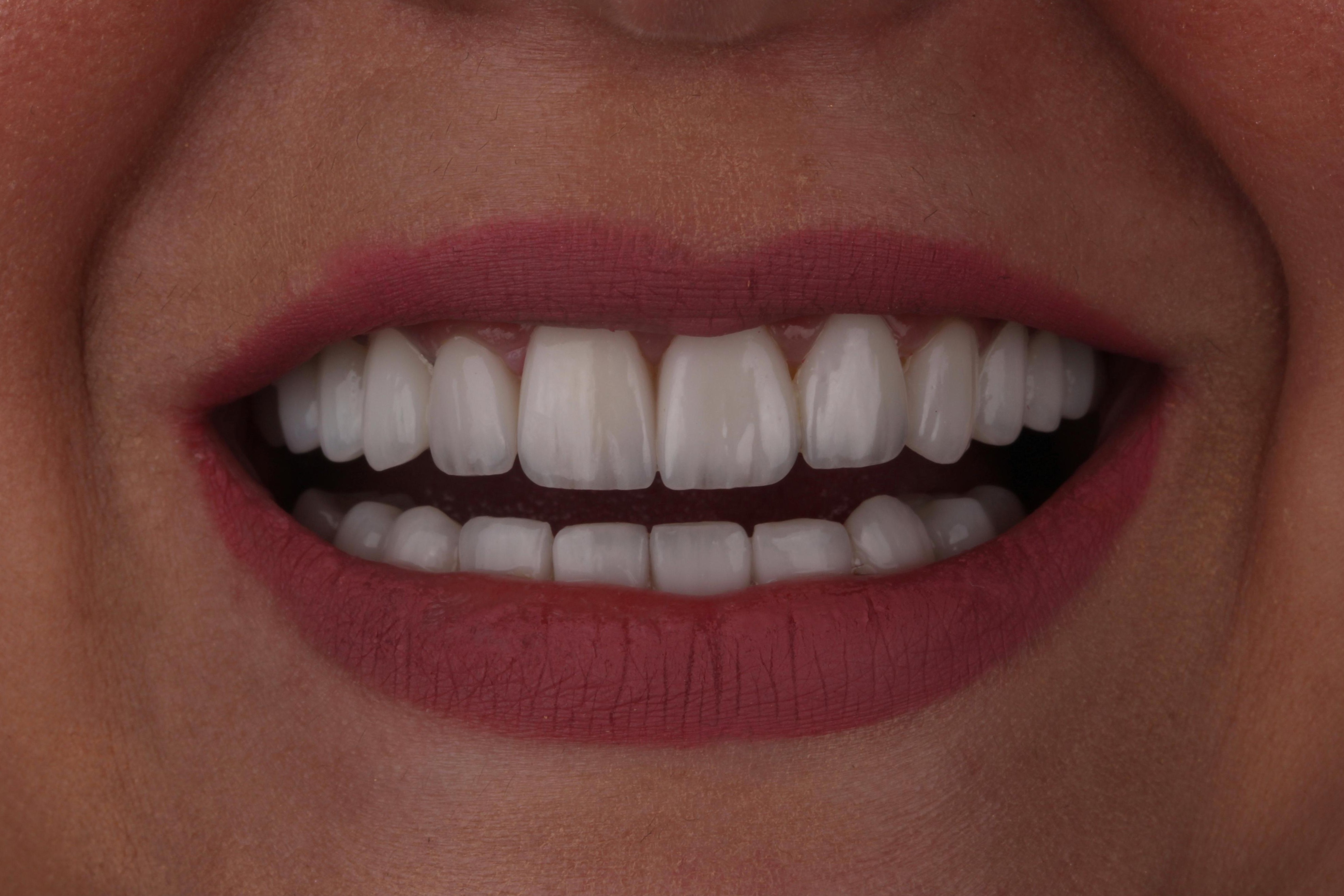 After veneers