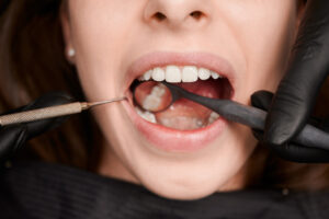 tooth decay
