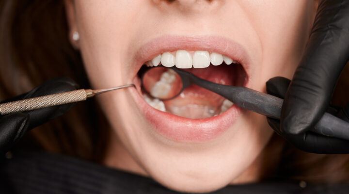 tooth decay