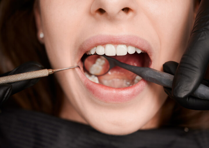tooth decay