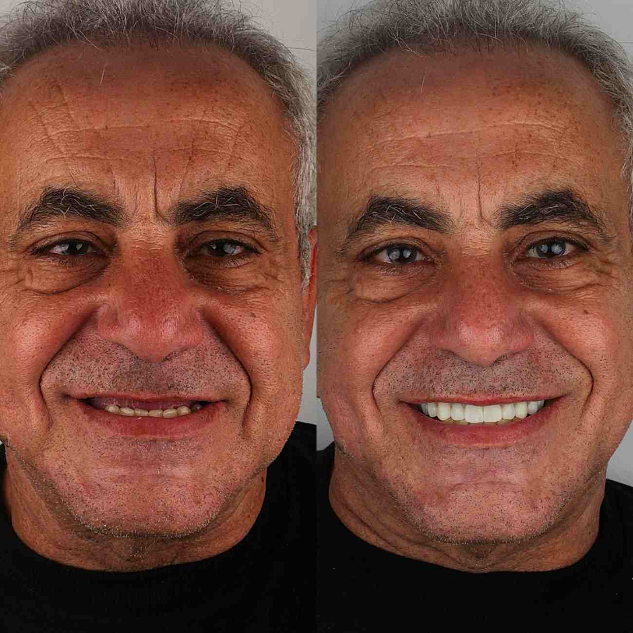 dental implanyts