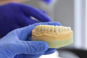 E-Max Dental Crown
