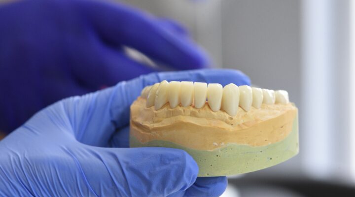 E-Max Dental Crown