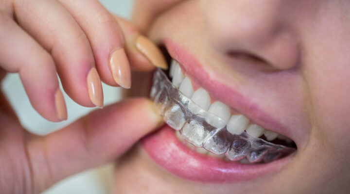 clear aligners