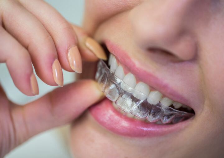 clear aligners