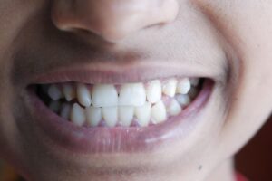 White Spots on Teeth