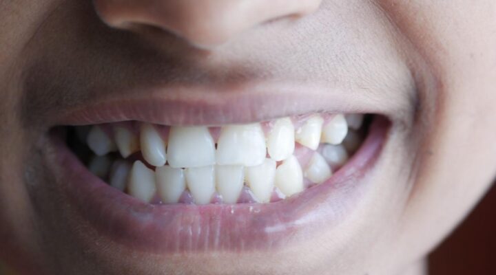 White Spots on Teeth